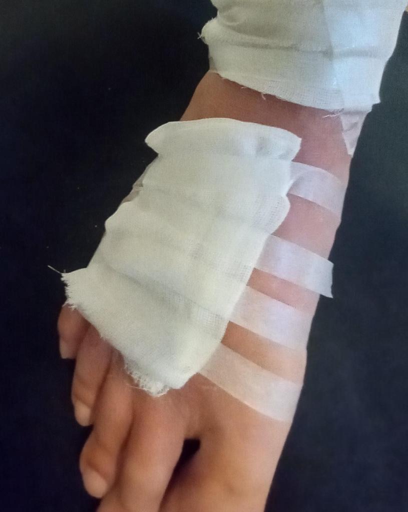 足のヤケドを治療中